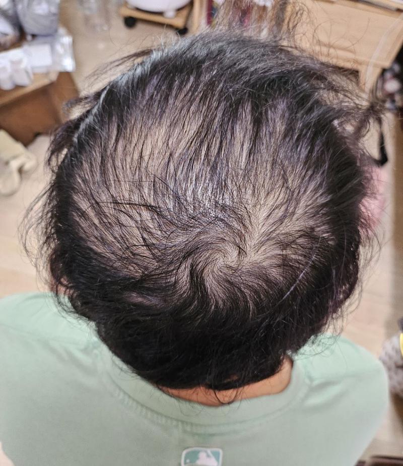 頭頂部大量移植狎鴎亭ポヘア医院非切開毛髪移植当日のレビューです