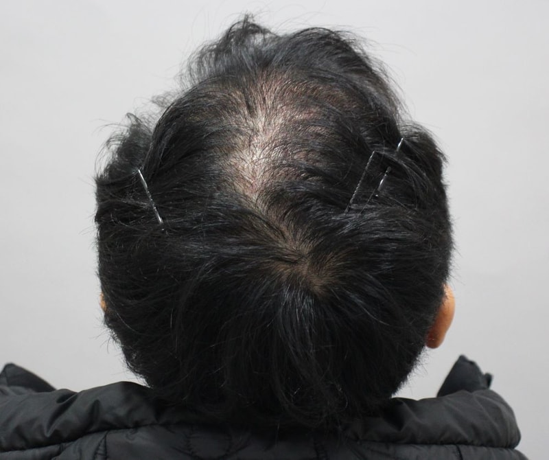 06.수술2주차.JPG