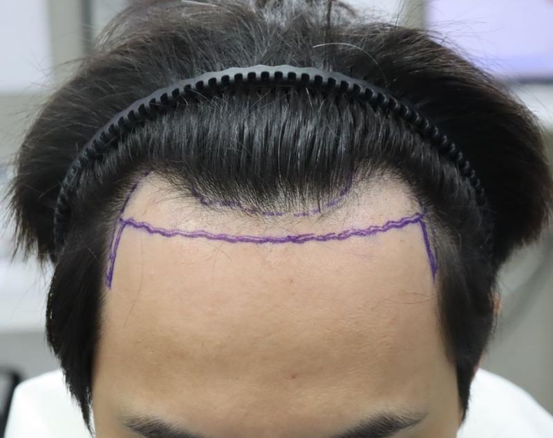 实时采集，移植毛发移植 3 个月狎鸥亭FORHAIR医院后记