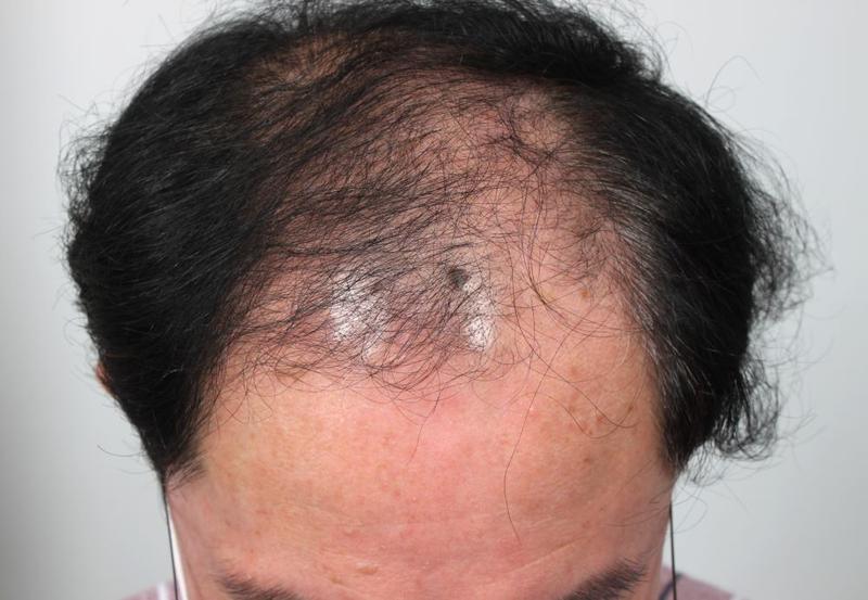 모발이식으로 젊어지기 부산포헤어 비절개모발이식 암흑기 1달차 후기