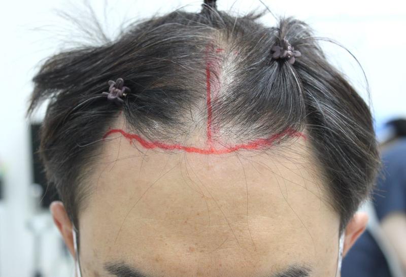 釜山FOHAIR医院非切开无削发毛发移植 1617毛囊第2周后期
