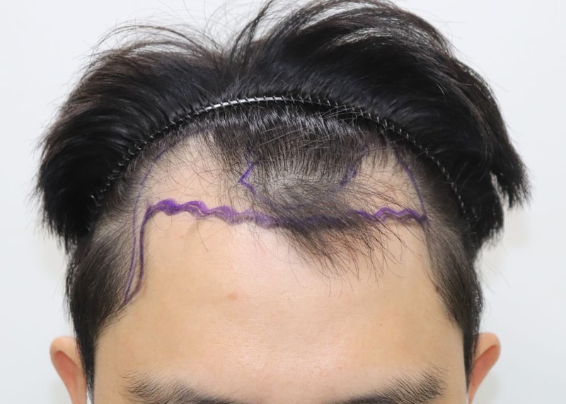 대구 포헤어의원 M자탈모+측면 비절개 슬릿 모발이식  4개월 후기