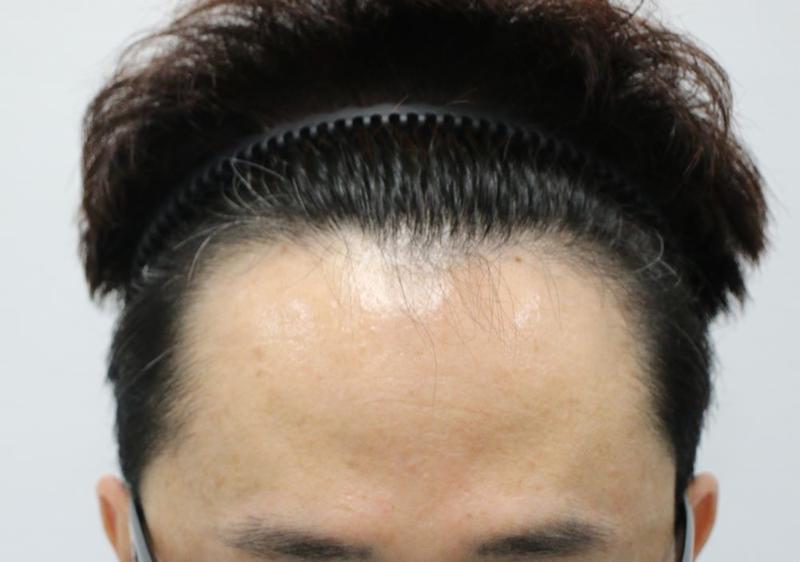 Men's Hairline Correction Apgujeong Forehead Clinic Non-cut Hair Transplantation for 4 months