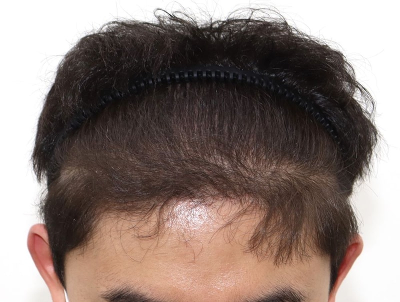 04.수술7개월_헤어라인.JPG