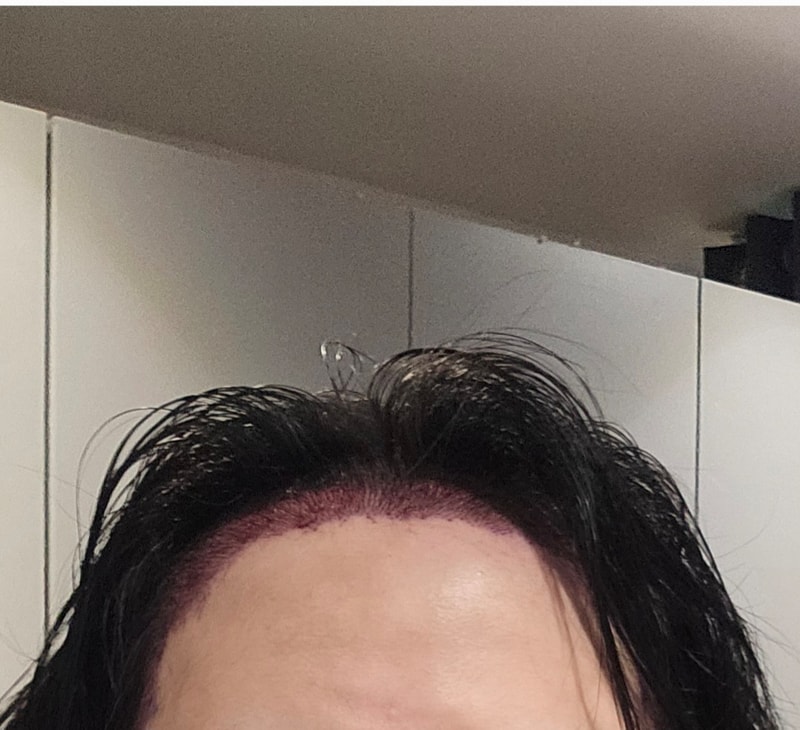 디에이 모발이식 4000모