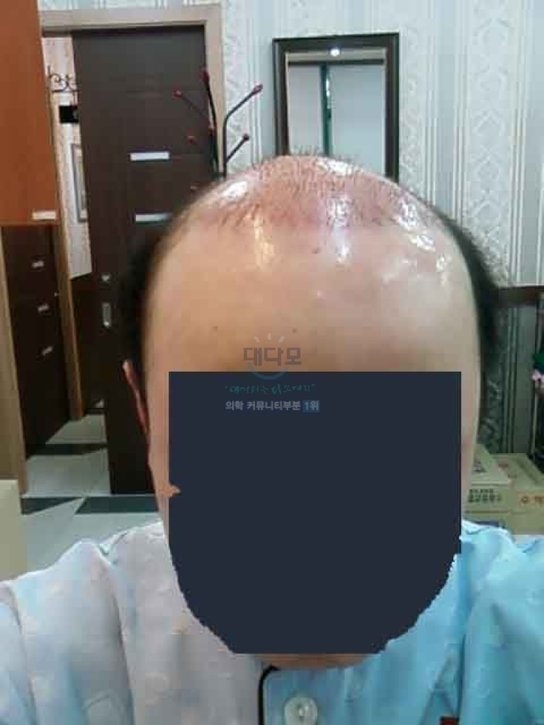 절개수술사진.jpg