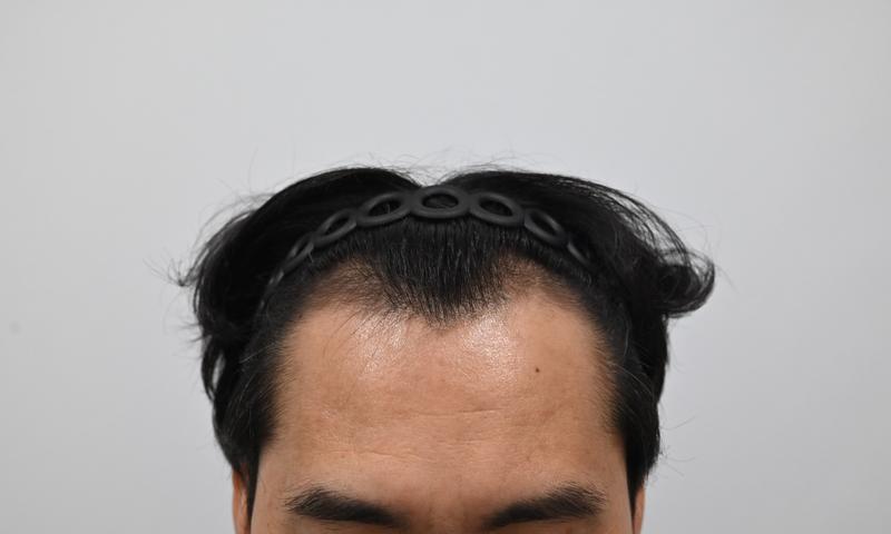 모엠의원 비절개 히든컷 모발 이식 후기