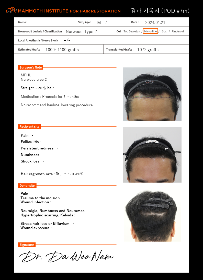 압구정 맘모스 비절개모발이식 7개월 후기 (남다우 원장님)