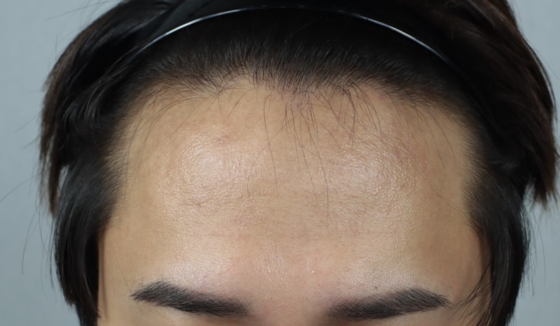 Modi Hair Implant M-shaped Hair Transplantation 2 weeks later