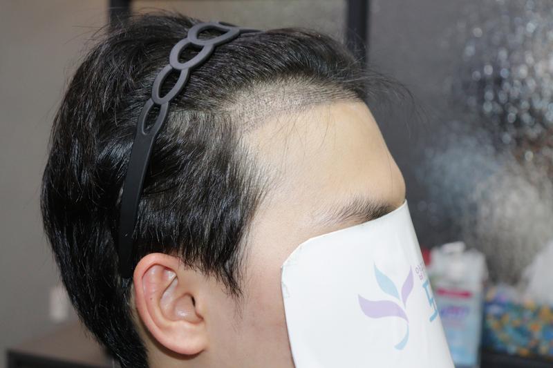 수술 2주차 후기