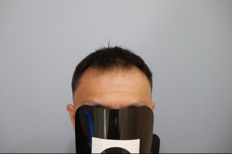 광주 압구정 모비앙 의원 10개월 경과 후기