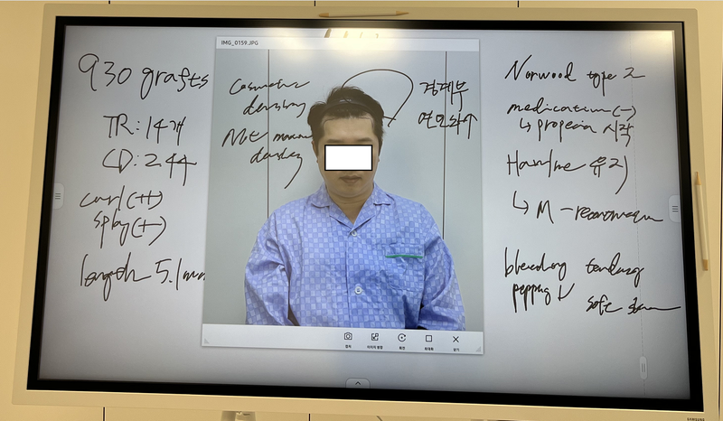 狎鴎亭マンモスヘアライン医院のM字毛髪移植2週間後のレビューです。 写真
