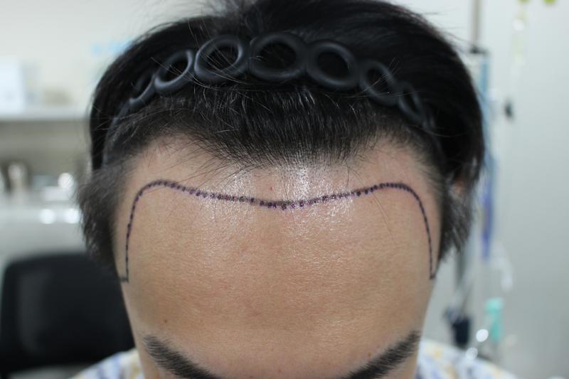 모다올 양유군원장님 헤어라인 비절개 모발이식 3200모+@후기