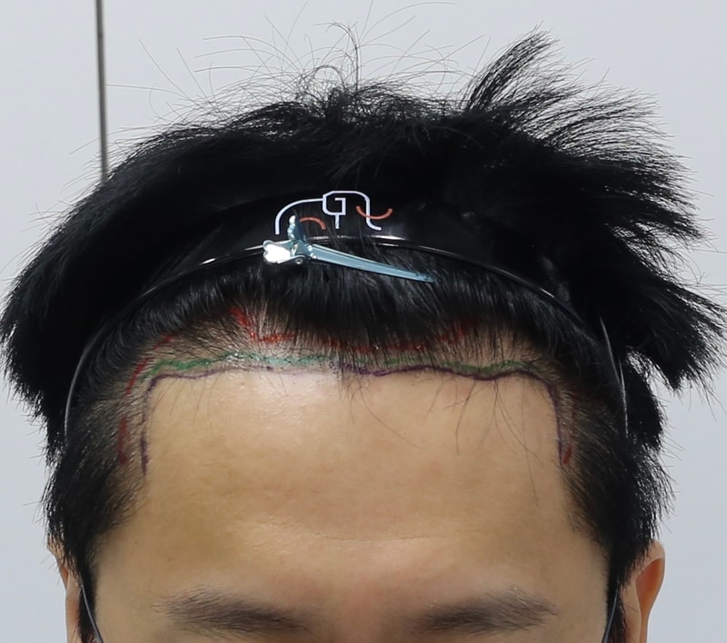 압구정 맘모스 남다우 비절개 모발이식 : 4개월 후기