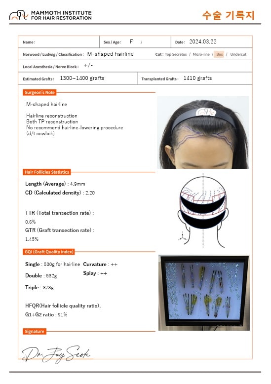 This is a detailed review of the wide forehead hairline correction. (Doctor Slits, Physician Transplantation)