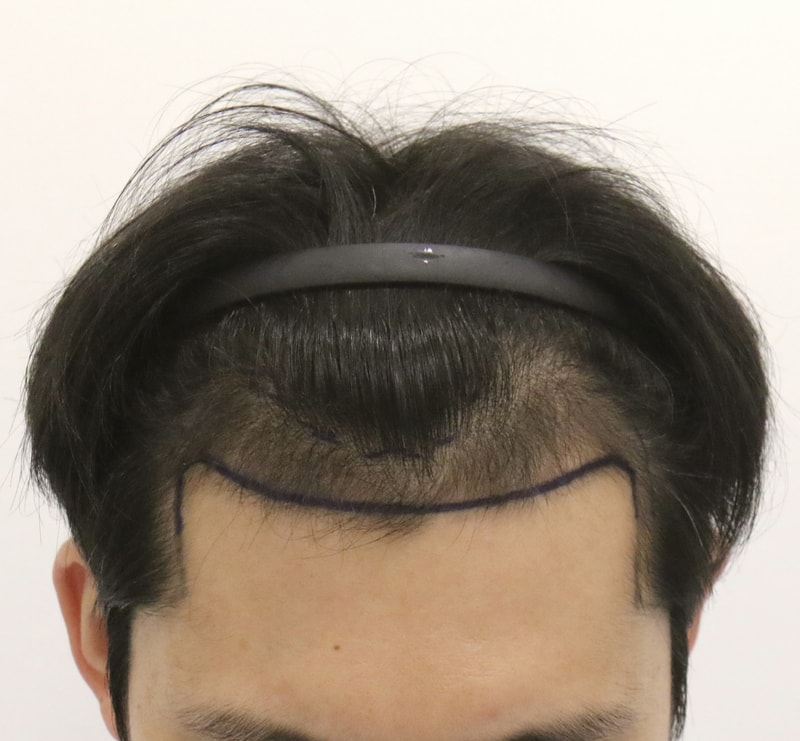 釜山植毛 マンモスヘアラインクリニック手術体験談。 本当に感謝の気持ちです。