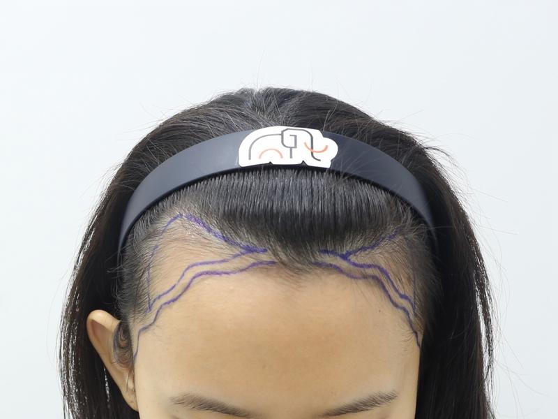 It's the 7th month of mass hair transplantation for wide forehead.