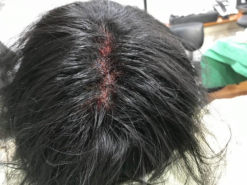 伸びる 2000毛 手術直後後記 (為替恐怖症にご注意ください)