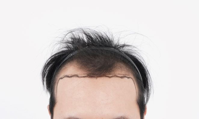 M자 비절개3800모 이식 1년차 후기