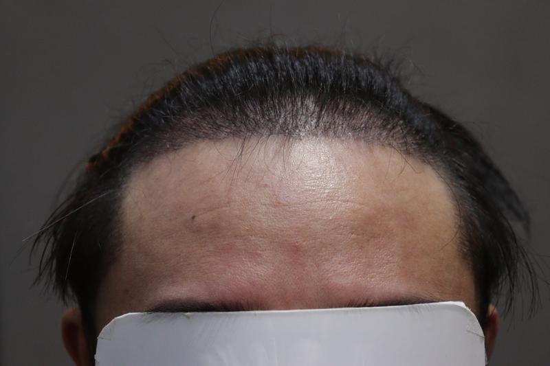 광주압구정모비앙의원 10일차 경과후기