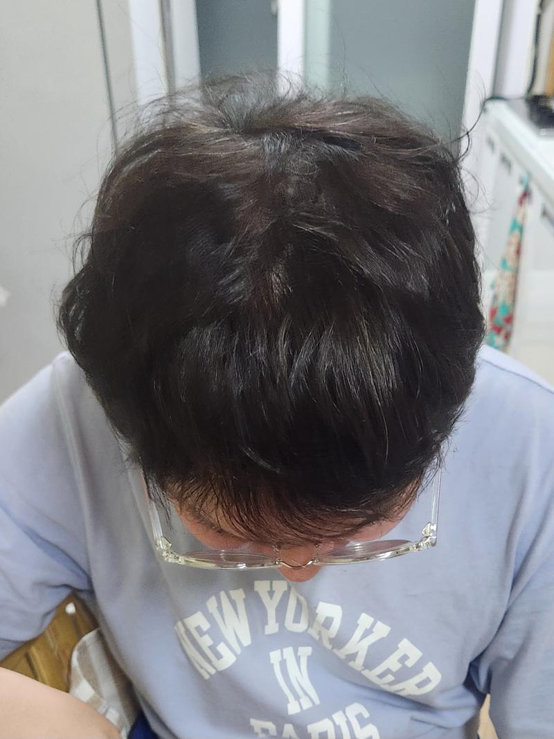 毛材性毛发移植8个月
