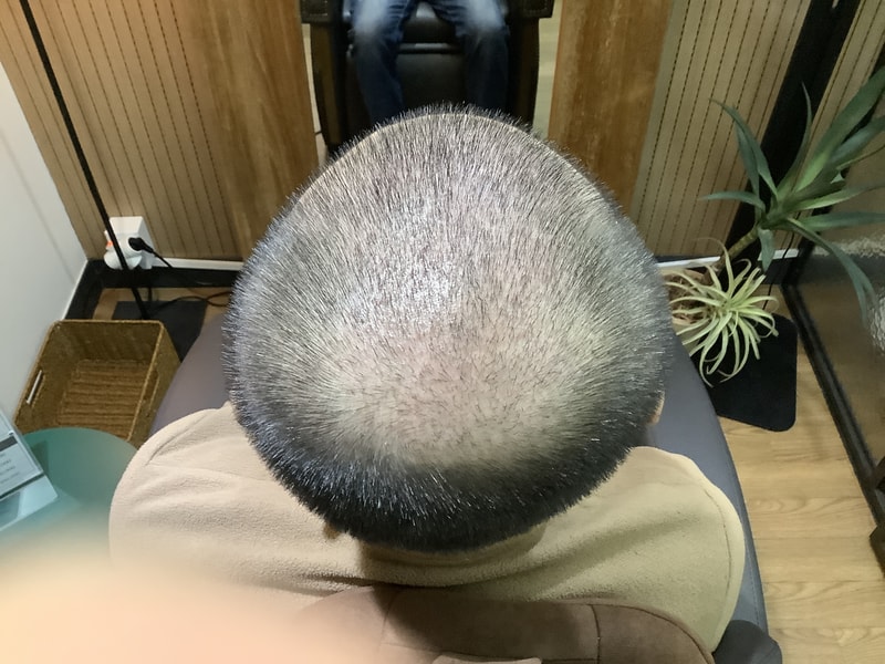 자라다의원 비절개 2주째 후기
