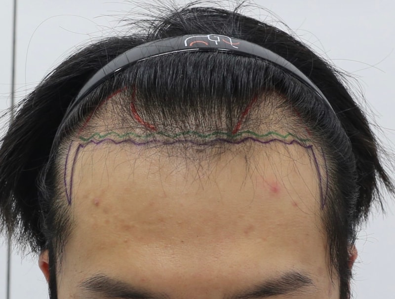 8 months of non-excisional Hair Transplant (Director Nam Da-woo, Mammoth Hair Restoration Center, Diamond Slit)