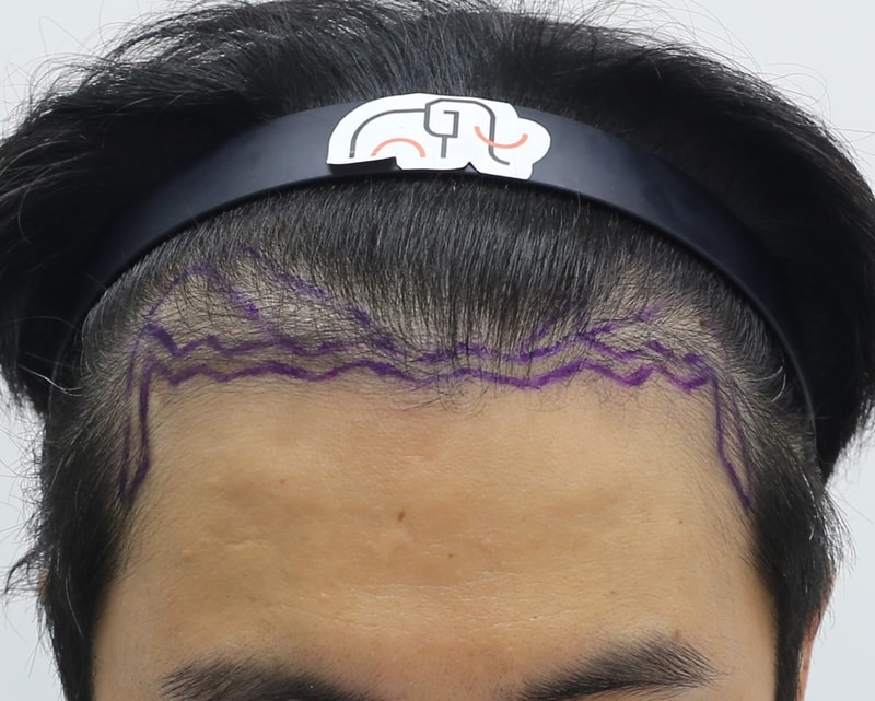 10 months final review of Apgujeong Mammoth Hair Restoration Center, director Nam Da-woo's diamond slit Hair Transplant