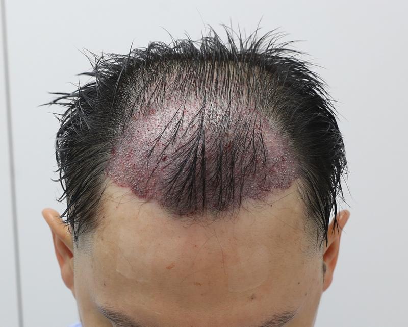 扩散性脱发大量毛发移植7个月后期。 多亏了南多宇院长,人生完全颠覆了。
