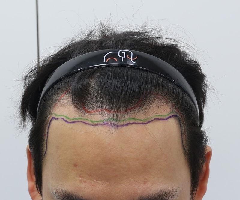 압구정 맘모스헤어라인 M자 모발이식 석지웅 원장님 10개월차