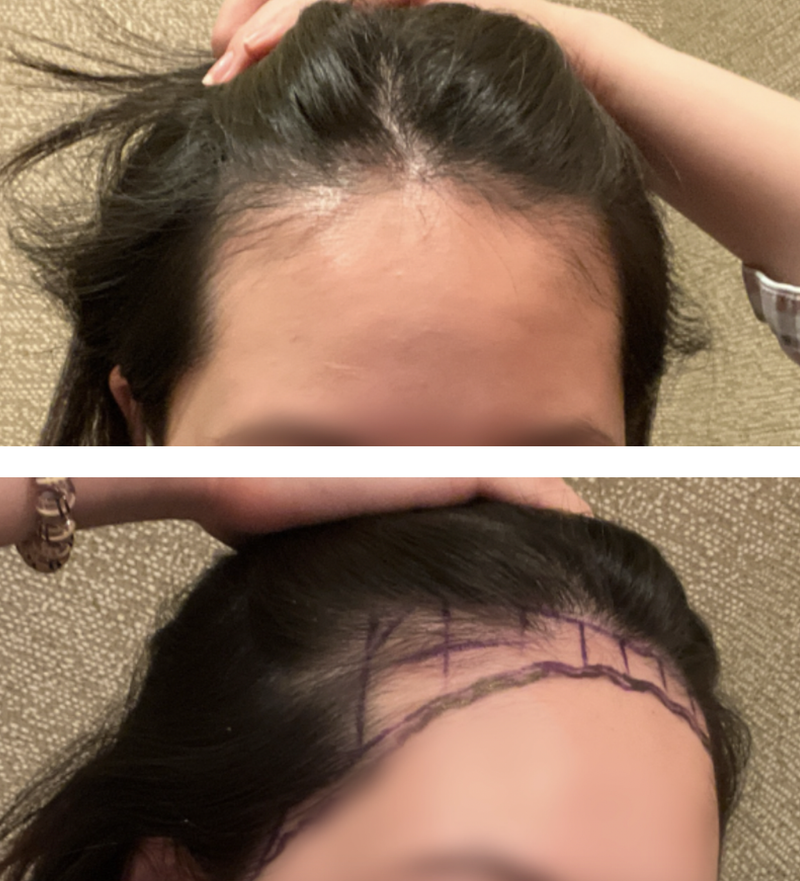 Review of the 7th month of 1600 hair follicles
