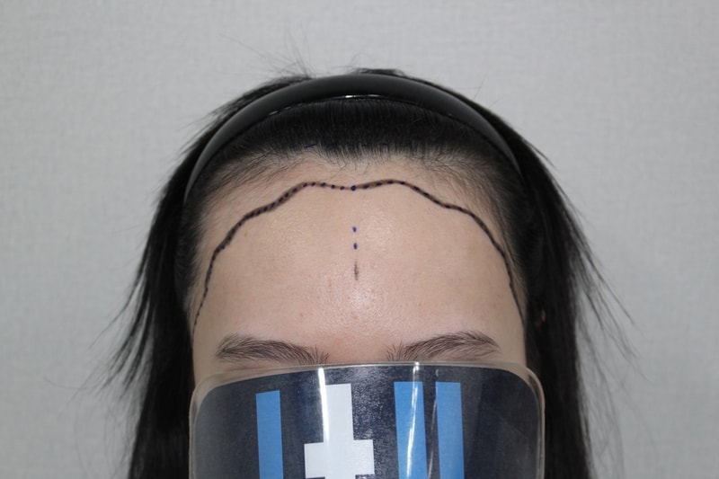 여성 헤어라인 대량모발이식 수술당일후기