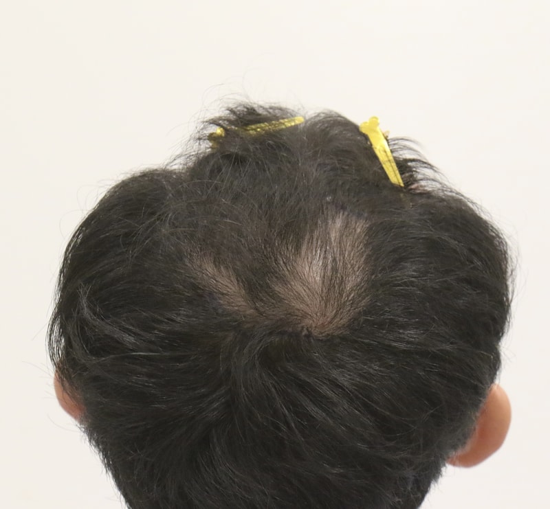 부산 비절개 모발이식 후기 : M자 + 정수리, 맘모스 헤어라인의원 김지석 원장님