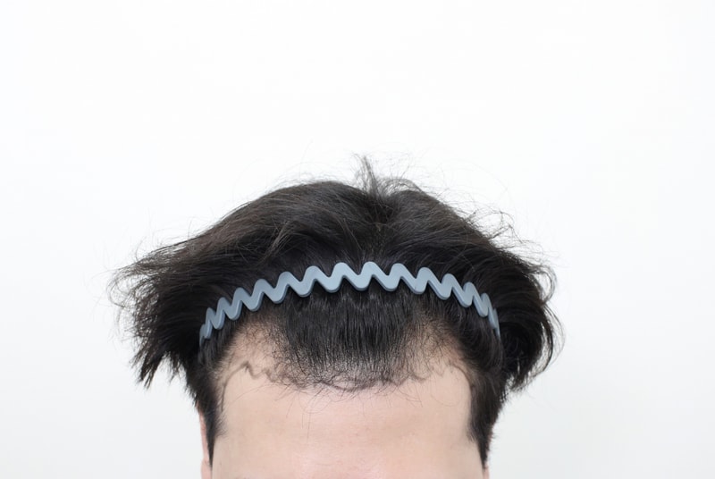 M자 모발이식, 모프로의원, 신사역, 6개월 경과