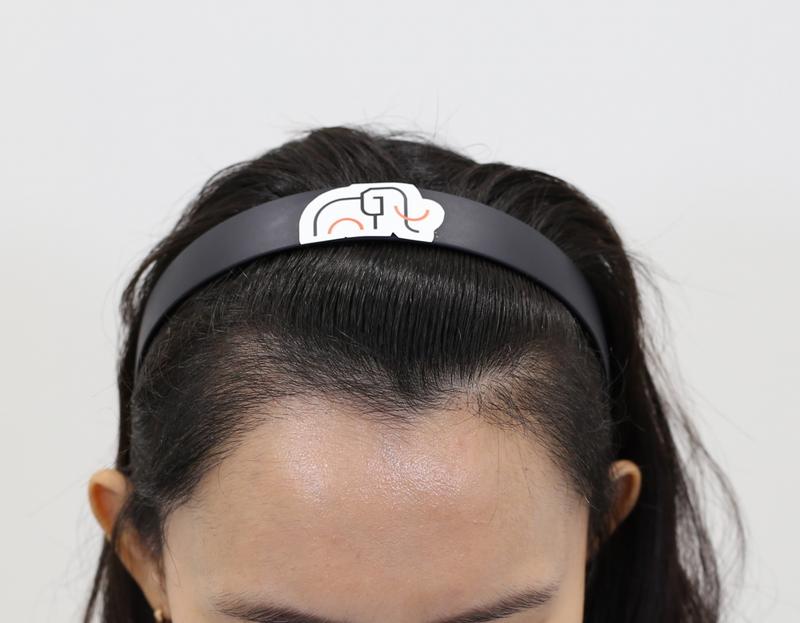 Wide forehead mass hair transplant in late 4 months (Apgujeong mammoth)