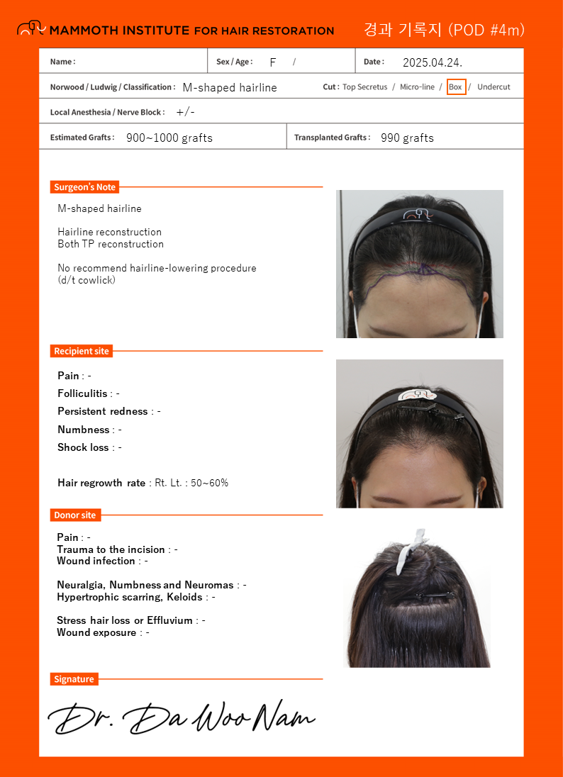 産毛維持 ヘアライン矯正 4ヶ月後のレビュー - 狎鴎亭マンモスのナム·ダウ院長