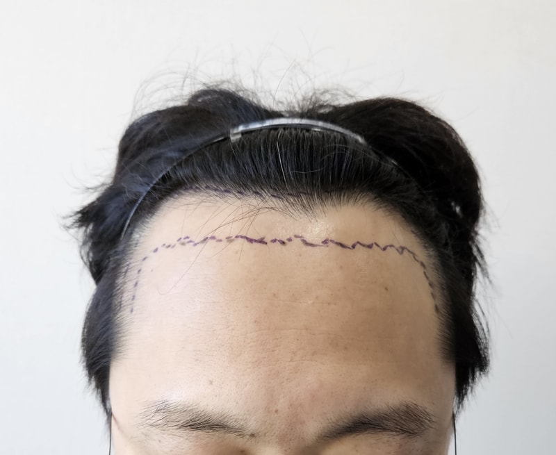 狎鴎亭毛再形成外科 4000毛 鼻切開 手術後のレビュー