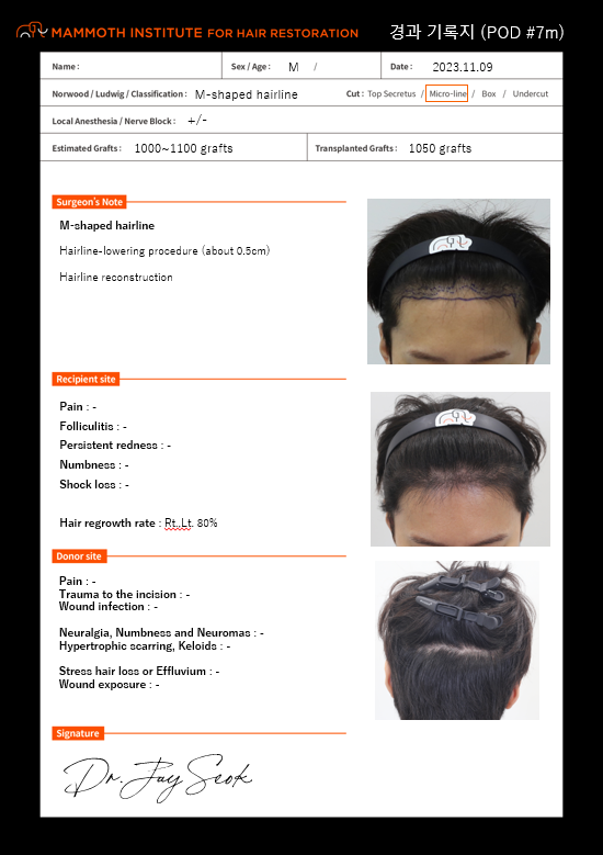 Apgujeong Mammoth Non-Cutting Slit Hair Transplantation Late 6 Months. You've grown a lot