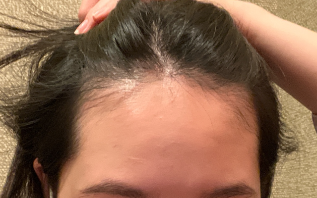 8th Month of Hair Transplantation Review