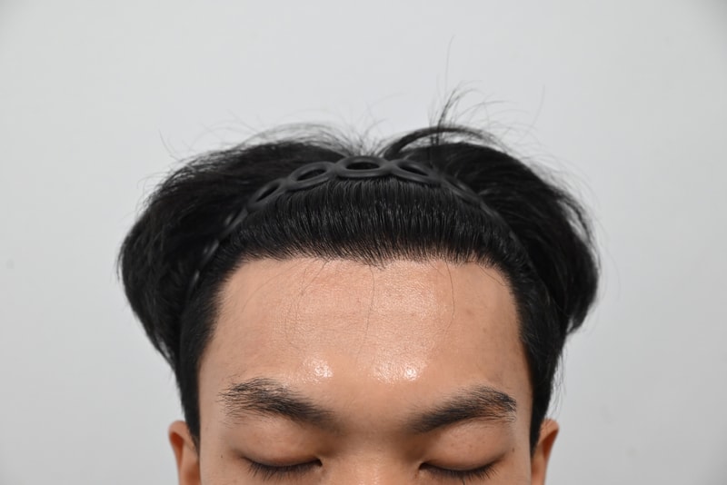 심고 나니 왜 이제야 했나 싶습니다…모발이식 후 9개월차 후기