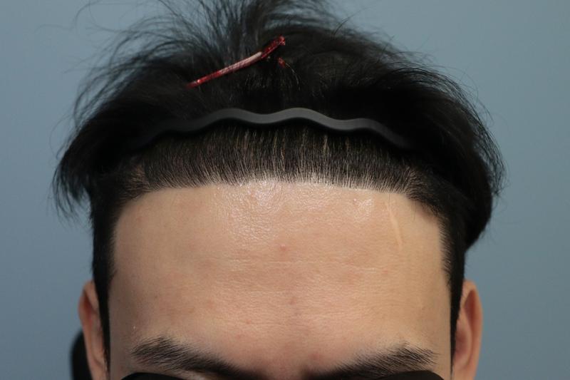 [압구정모비앙] 절개 6개월 후기