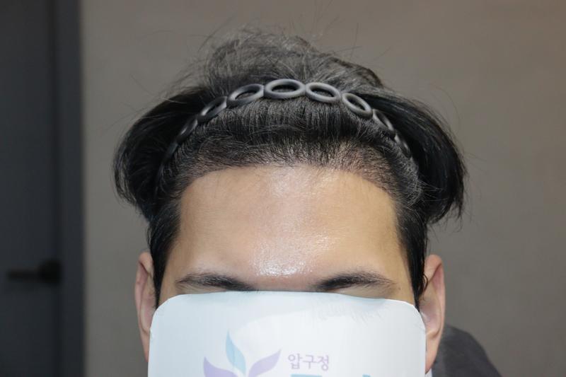 광주 압구정모비앙 모발이식 2주차 후기