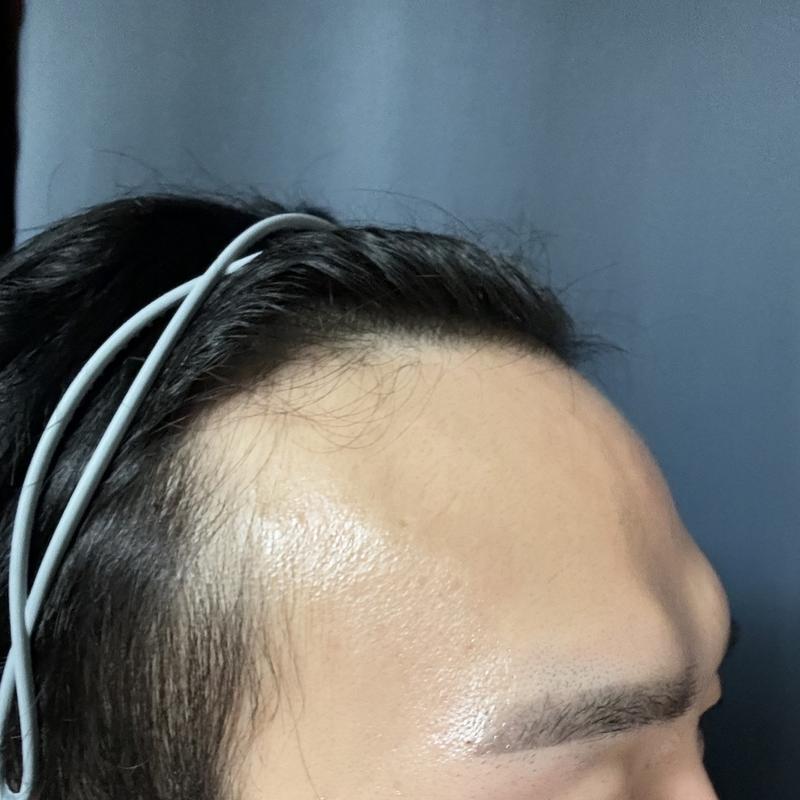 디에이성형외과 5500모 모발이식