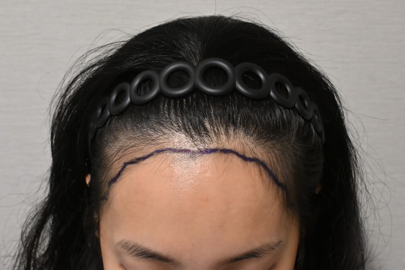 Hairline Hair Transplant review (Director Hong Jun-hyun)