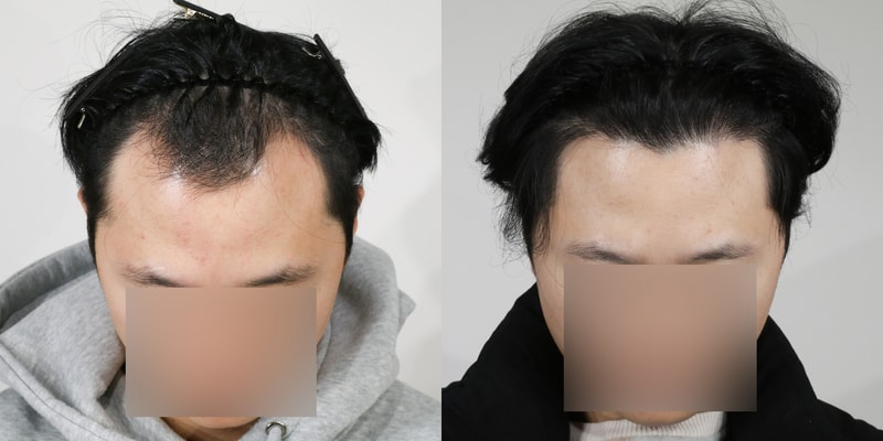 압구정 모우림의원(사진첨부) 절개 모발이식 수술 1년 후기