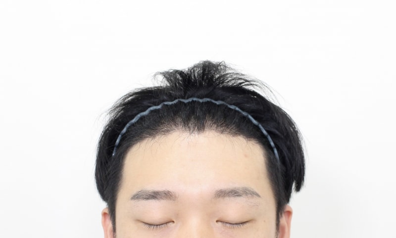 모프로 의원 헤어라인 모발이식 비절개 4200모 6개월 경과