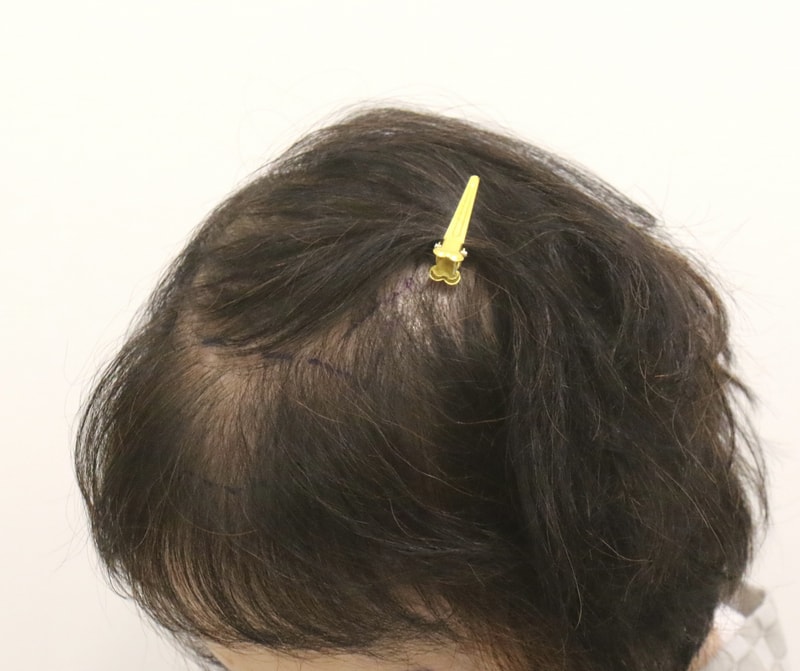 부산 모발이식 맘모스헤어라인 정수리 오늘 수술 후기 나눠요..