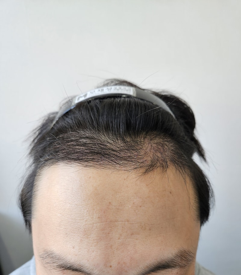 압구정 모재성성형외과 4000모 비절개 수술 4개월차 중간 후기 (7/26 수술 → 11/29)