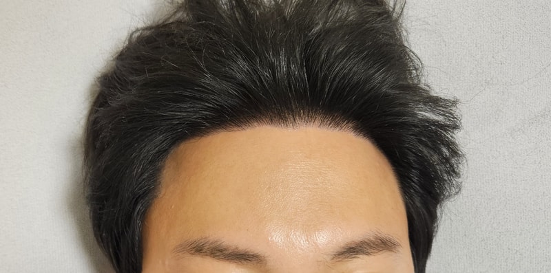 (295일)전지훈원장님 4천모 비절개 히든컷