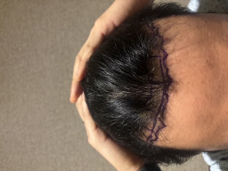 강남모발이식병원 뉴헤어 6일차 절개모발이식 1700모낭 후기입니다.
